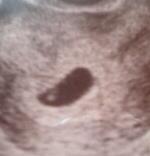 妊娠2ヶ月目(5週目)超音波写真　胎嚢(たいのう）のエコー