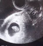 妊娠２ヶ月目超音波写真