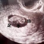 妊娠3ヶ月目(10週目)超音波写真