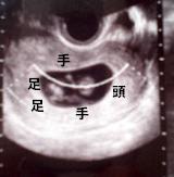 娠3ヶ月目(10週目)超音波写真