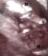妊娠4ヶ月（妊娠13週）超音波写真