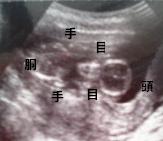 妊娠4ヶ月（妊娠13週）超音波写真