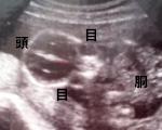 妊娠5ヶ月（妊娠17週）超音波写真