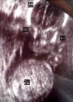 妊娠6ヶ月（妊娠21週）超音波写真