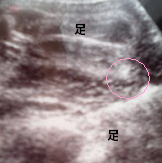 妊娠7ヶ月の赤ちゃんの超音波写真
