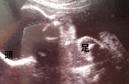 妊娠7ヶ月（妊娠25週）超音波写真